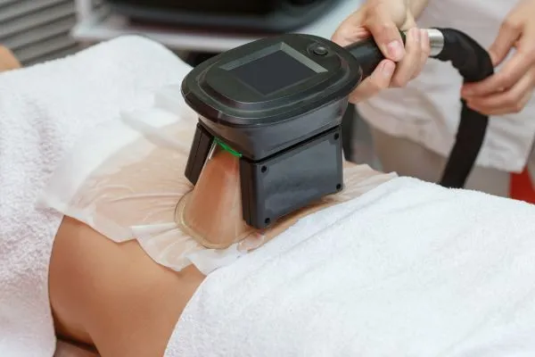 Image of person having fat freezing treatment to help weight gain Wilmslow