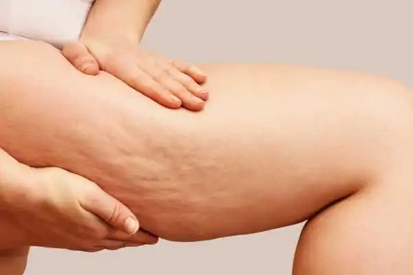 Image of woman showing leg with cellulite Wilmslow