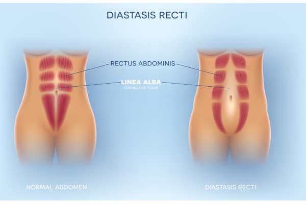 What Non-Surgical Options Are Available for Diastasis Recti Wilmslow?