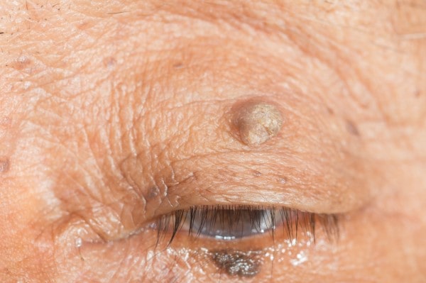 Skin imperfections Wilmslow - Cryopen is fast and effective book in today!