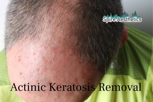 actinic keratosis