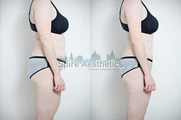 before and after cryolipolysis