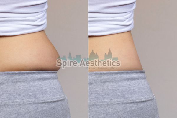 before and after cryolipolysis