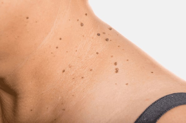 Are you looking for easy skin tag removal Wilmslow - then contact Spire today!