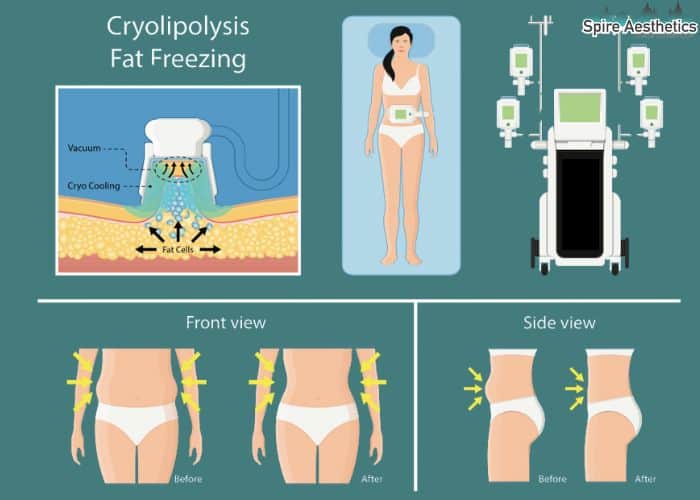 Image of diet and fat freezing combined for best results for Spire Aesthetics Wilmslow