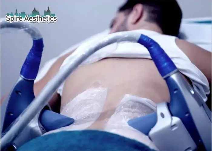 Man having fat freezing treatment done on love handles before a competitions Wilmslow to create a sculpted look.