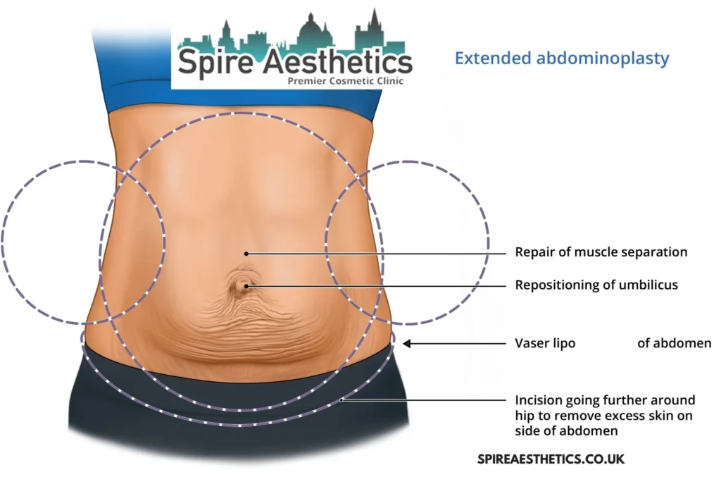 Understanding Loose Skin After Gastric Band Wilmslow Surgery and HIFU Treatment 