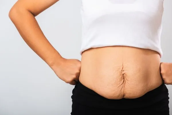 Image of a woman's stomach after weight loss with sagging skin following a gastric band Wilmslow