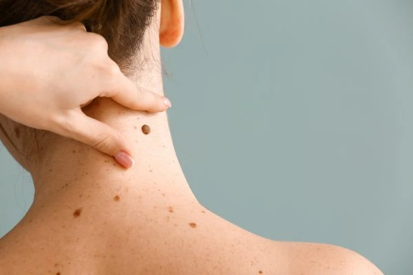 skin blemish removal Wilmslow treatment