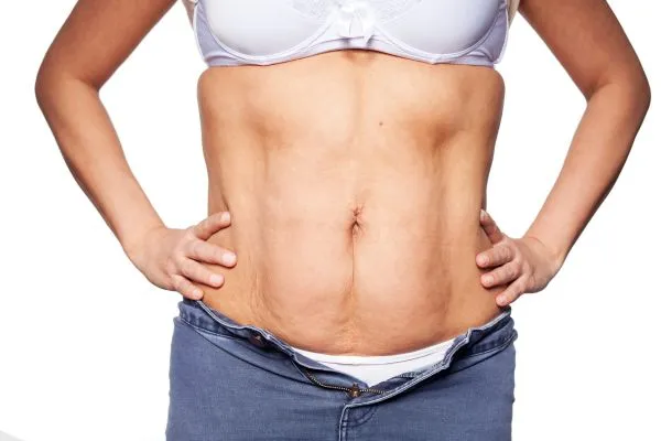 sagging skin on woman's stomach after weight loss injections Wilmslow