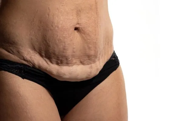 Image of womans stomach after weight loss injections Wilmslow showing saggy skin