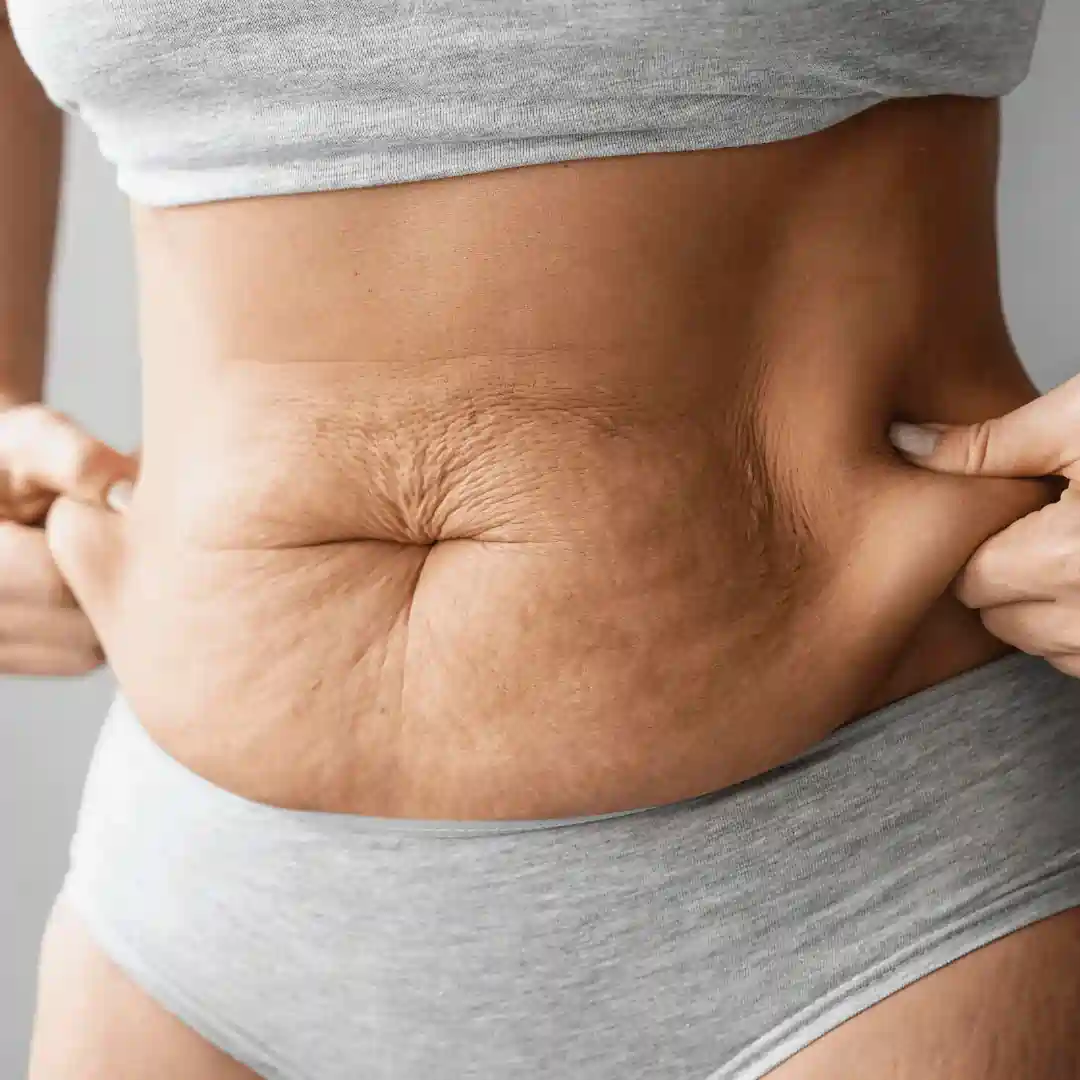 Is It Normal to Have Loose Skin After Pregnancy Wilmslow?