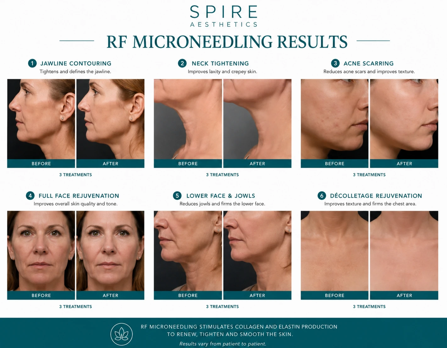 RF Microneedling Skin tightening Wilmslow results