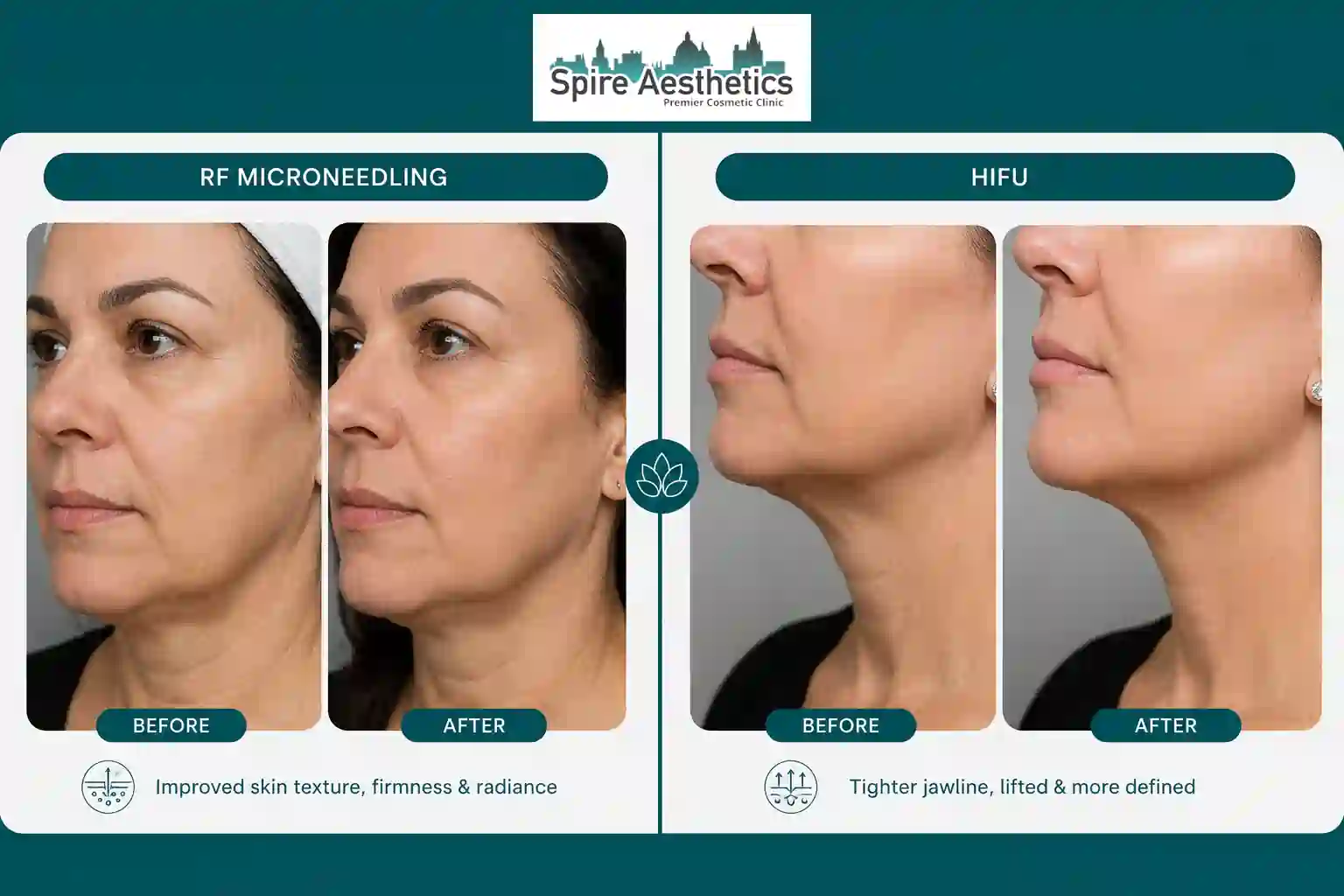 Can RF Microneedling and HIFU Be Combined Wilmslow?