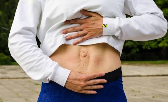 When Could Diastasis Recti Be the Missing Piece of the Puzzle Wilmslow?