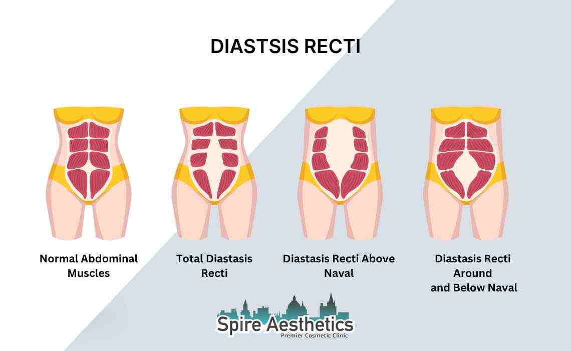 Is Non-Surgical Diastasis Recti Treatment Right for You? Common Concerns Answered Wilmslow